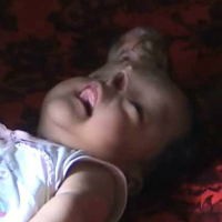 Bayi Tanpa Hidung Lahir di Pekalongan