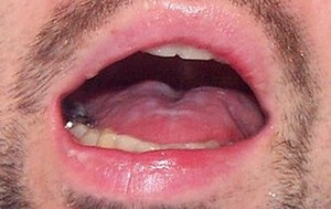 Dysarthria