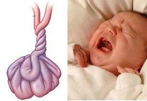 Muntah Hijau, Tanda Usus si Kecil Terpuntir