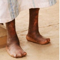 Mengucilkan Orang Kusta Tanda Masyarakat Sakit  