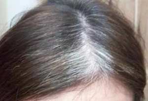 Rambut Ubanan Tanda Kesembuhan Pasien Kanker Kulit