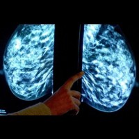 Ciri-ciri Kanker Payudara