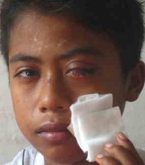 Tak Bisa Sembuh, Mata Hari Wibowo Buta