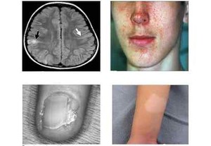 Penyakit Tumor Keturunan yang Sulit Didiagnosis
