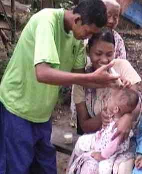 Balita Tanpa Rongga Mulut Segera Dioperasi