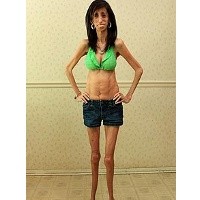 Sudah Makan 60 Kali Sehari, Tubuh Lizzie Tak Bisa Serap Lemak 