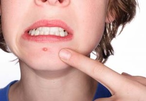 Mencegah Munculnya Jerawat Menjelang Menstruasi
