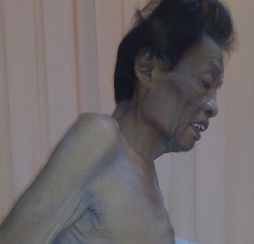 Kena Kanker Hati, 6 Liter Cairan Disedot dari Perut Cholik Syahmari