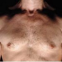 Pria Juga Bisa Kanker Payudara