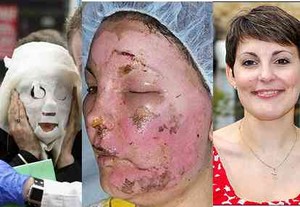 Muka Kembali Mulus Usai Sembuh dari Luka Bakar Akibat Bom