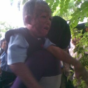Menkes Upayakan Operasi Plastik Ido, Bocah Korban Ledakan Gas