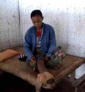 10 Tahun Busani Menderita Penyakit Kaki Gajah