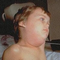 Jika Tak Ingin Mandul, Jangan Remehkan Gondongan