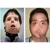 Permak Muka dengan Transplantasi Total Berhasil Dilakukan 