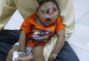 Arjuna, Bayi Berwajah Seram yang Nyaris Tak Berbentuk