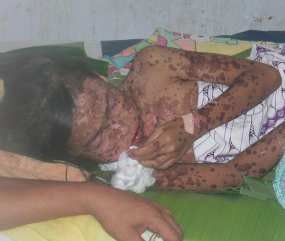 Minum Obat Resep Dokter, Tubuh Bocah SD di Mataram Melepuh