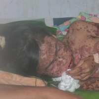 Minum Obat Resep Dokter, Tubuh Bocah SD di Mataram Melepuh