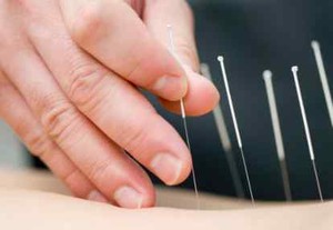 Akupunktur Tak Mempan Pulihkan Kondisi Setelah Stroke 