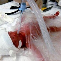 Bayi Prematur Selamat Berkat Kantong Plastik Sandwich