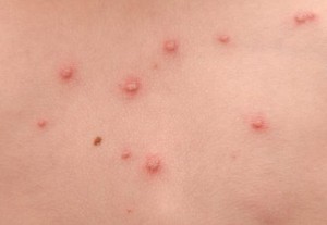 Seberapa Besar Cacar Air Bisa Menular?