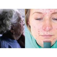 Penyebab Alzheimer dan Jerawat Sama?