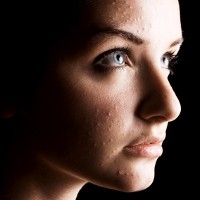 Cara Alami Menghilangkan Bekas Jerawat