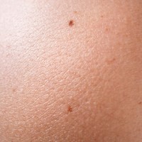 Banyak Tahi Lalat Pertanda Tulang Bagus
