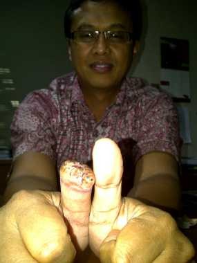 Kehilangan Jempol, Eko Trauma Naik Bus TransJakarta