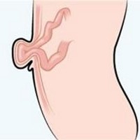 Pusar Ibu Menjuntai Karena Hernia Usai Melahirkan