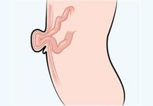 Pusar Ibu Menjuntai Karena Hernia Usai Melahirkan