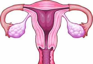 Mengobati Endometriosis Tanpa Obat 