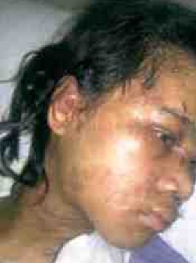 Kondisi TKW Armayeh Memprihatinkan