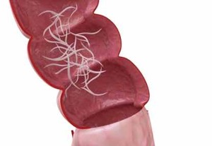 Awas! Cacing Kremi Bisa Menyerang Vagina 