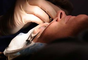 Yang Benar dan Salah Soal Lasik Mata
