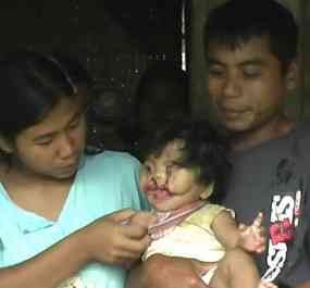 Susah Makan, Balita di Trenggalek Tidak Punya Dinding Mulut 