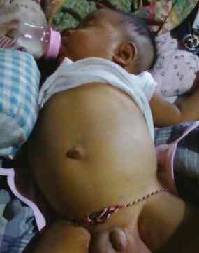 Kelainan Bayi Kediri Sangat Kompleks