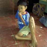 Help! Bocah 12 Tahun Lumpuh Diserang Tumor Ganas, Butuh Pengobatan