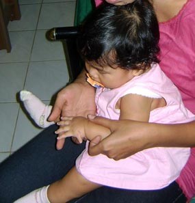 Agni, Balita Malang dengan 26 Jari