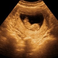 Mumi Janin Berdiam di Perut Wanita Selama 30 Tahun