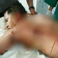 Kena Serpihan Bom, Kapolresta Cirebon Dioperasi