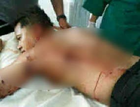 Kena Serpihan Bom, Kapolresta Cirebon Dioperasi