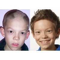 Bocah Hobi Cabuti Alis & Rambut Karena Gangguan Mental OCD