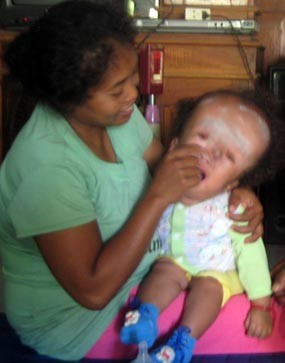 Bayi Hydrocephalus Ditelantarkan Dinas Kesehatan