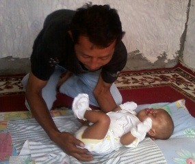 Bayi Tanpa Mulut & Hidung di Magelang Makin Memprihatinkan