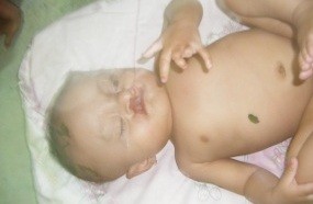 Bayi Suci Lestari di Garut Cacat Fisik Sekujur Tubuh