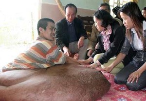 Pria yang Digeroroti Tumor Seberat 80 Kg