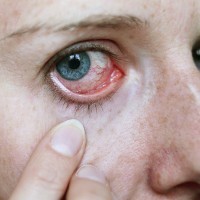 Orang Indonesia Tak Mau Donor Mata Karena Tabu 