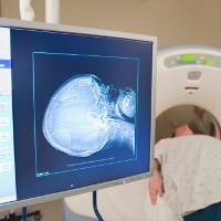 Kanker Otak dan Ciri-cirinya