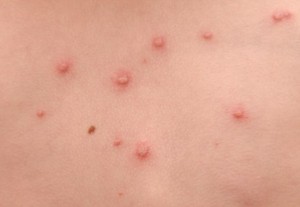 Acyclovir Liquid, Obat untuk Herpes dan Cacar Air