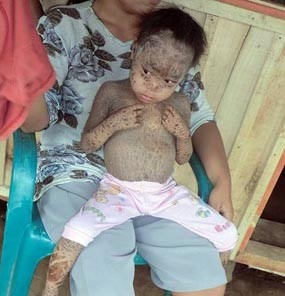 Kulit Balita Asal Malang Ini Dipenuhi Sisik
